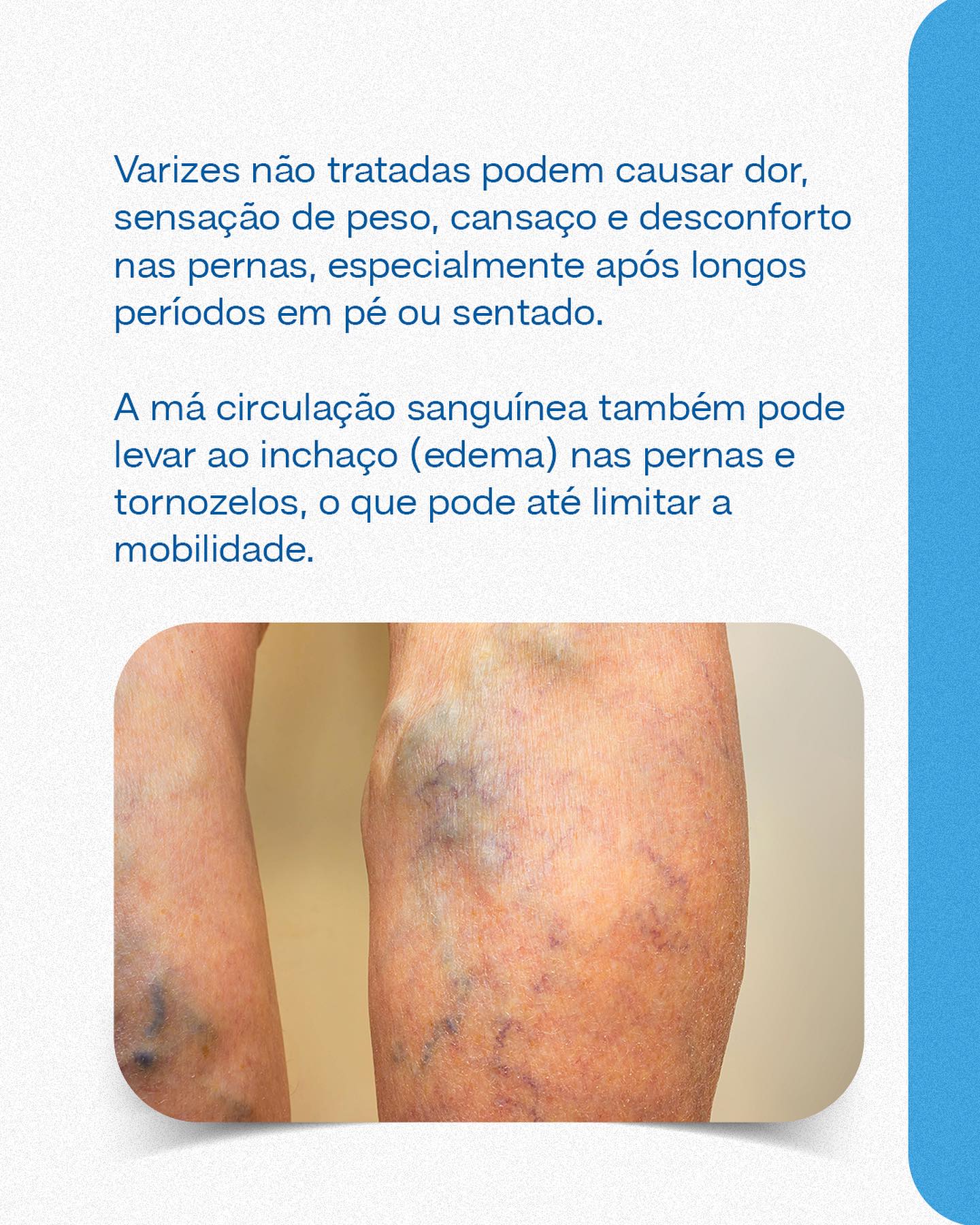 Não deixe que as varizes atrapalhem sua qualidade de vida.
