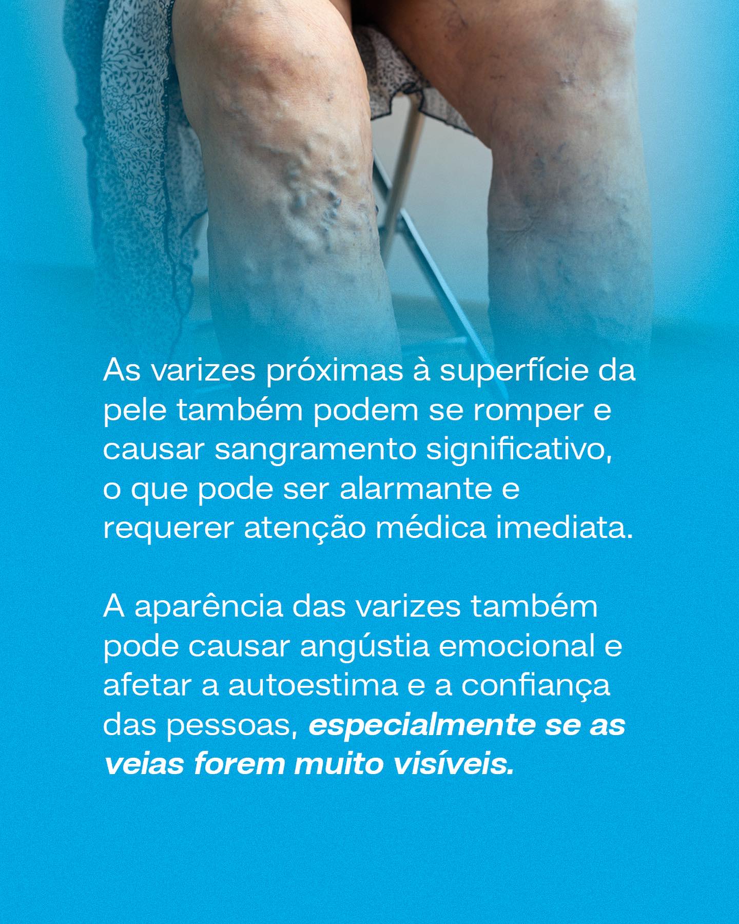 Não deixe que as varizes atrapalhem sua qualidade de vida.