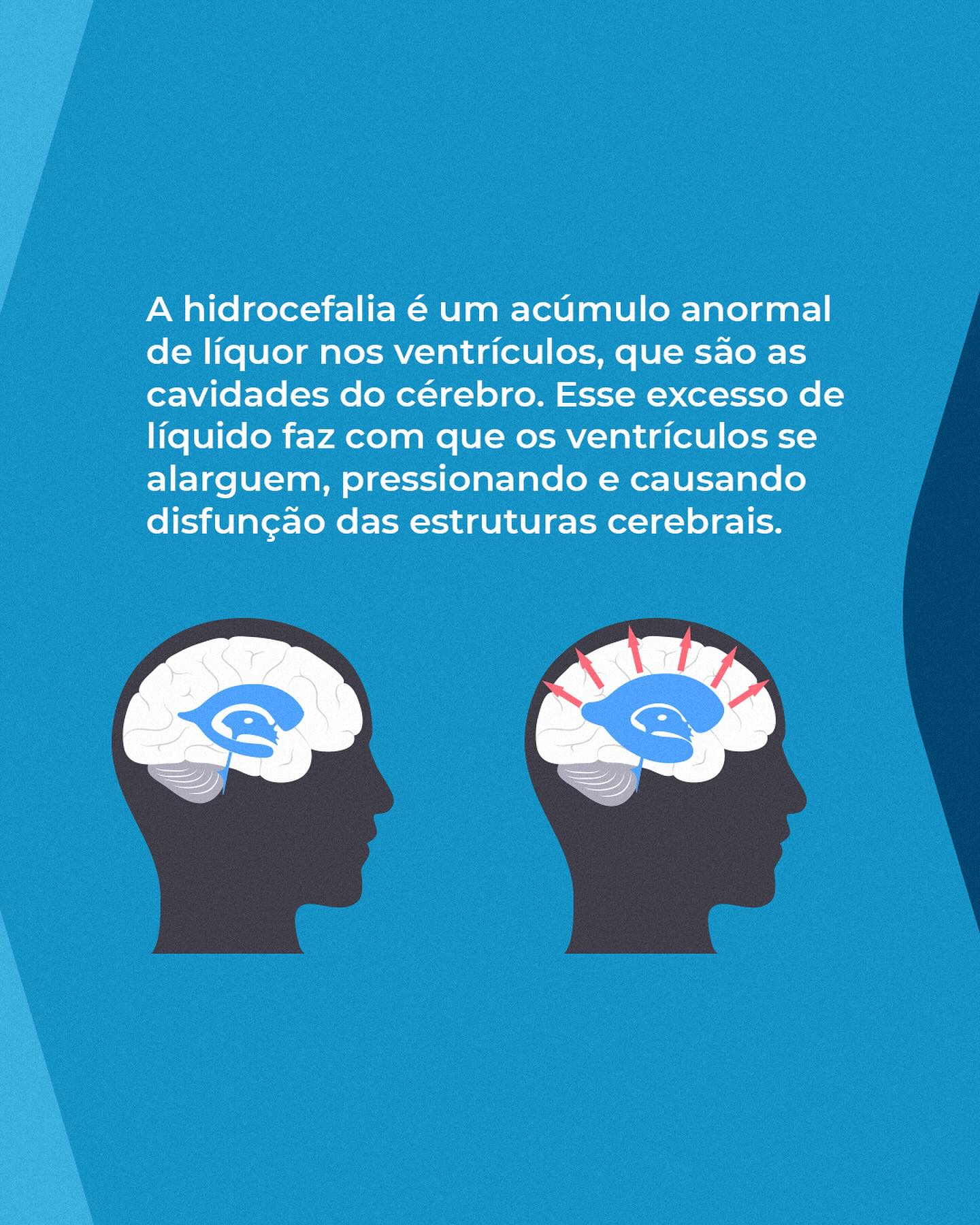 O que é a Hidrocefalia?