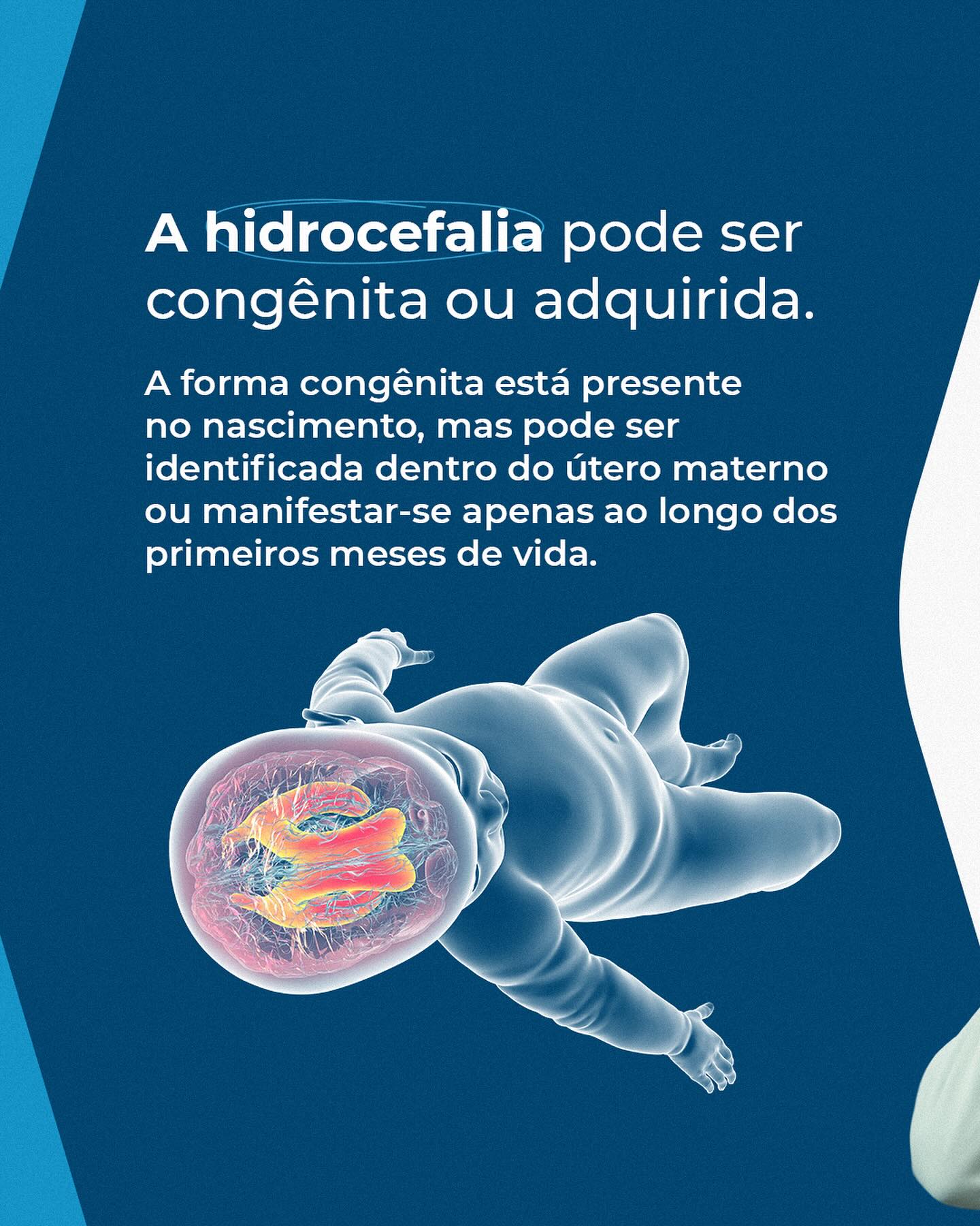 O que é a Hidrocefalia?