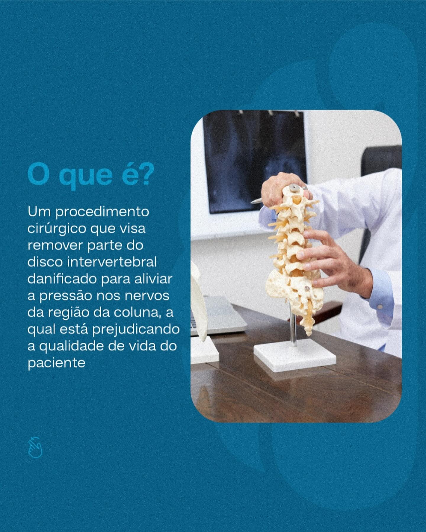 Discectomia como funciona?