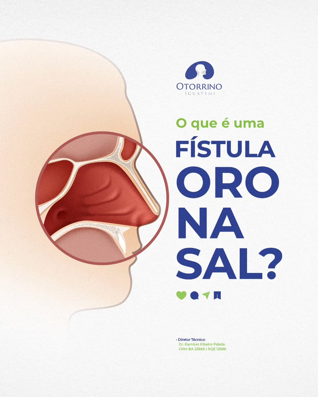 Não deixe que a fístula oronasal afete sua qualidade de vida.