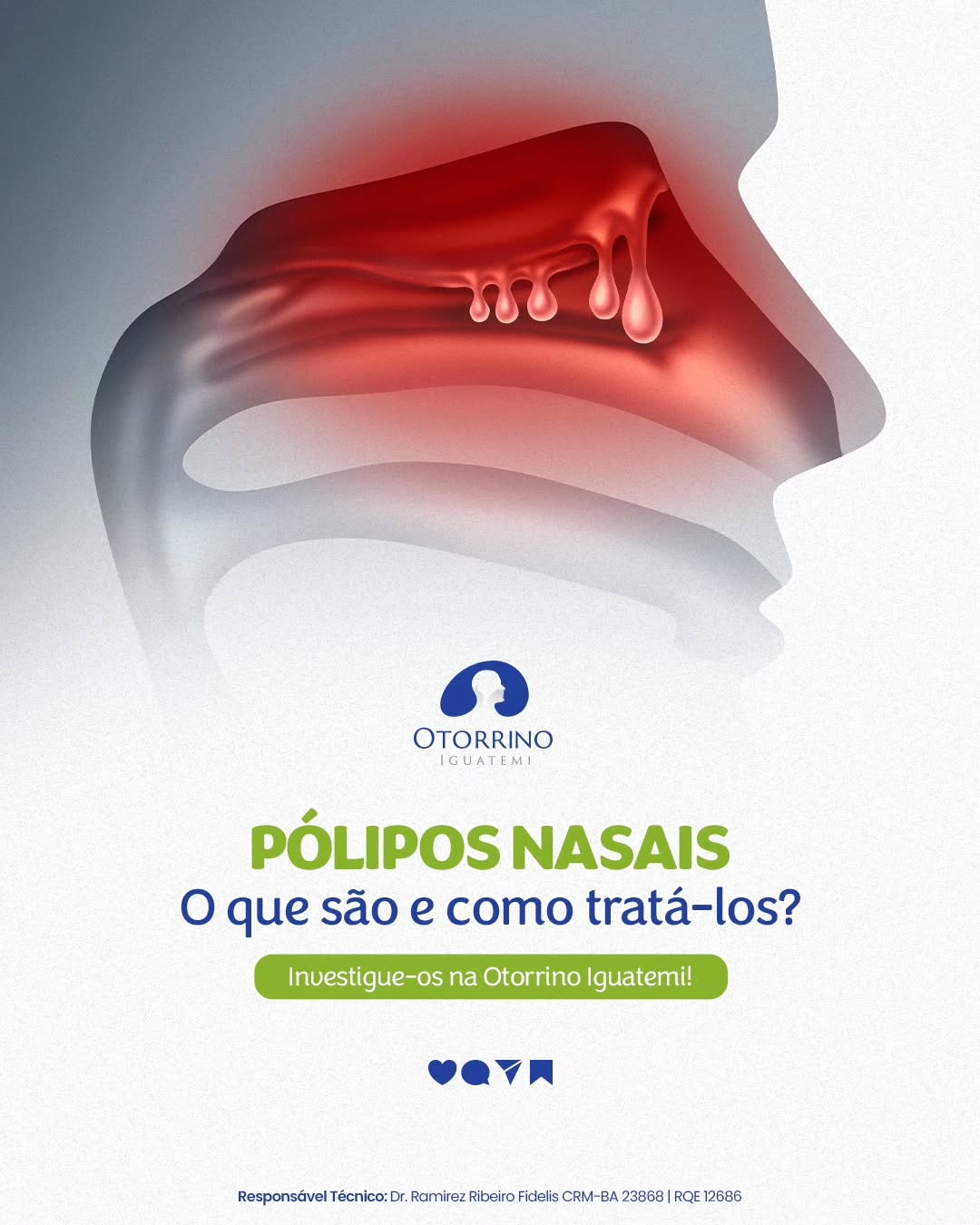 Pólipos nasais o que são e como tratar?