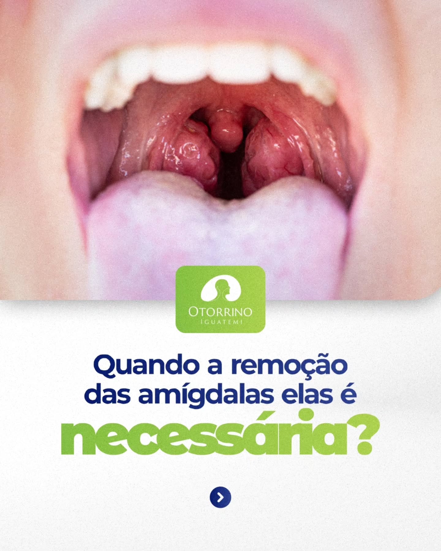Quais são as situações em que a remoção das amígdalas é necessária?