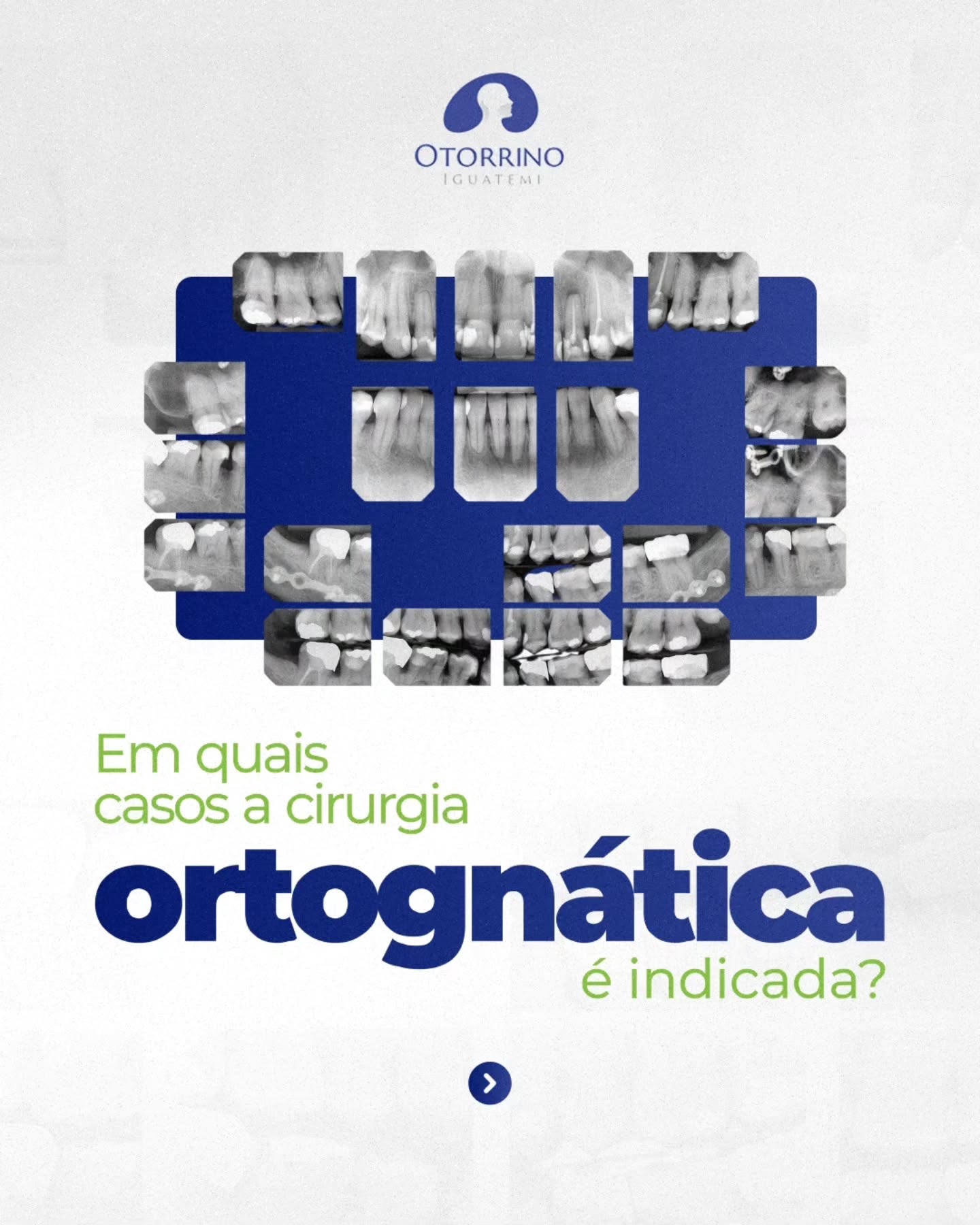 Quais são os principais casos em que a cirurgia ortognática pode ser a melhor solução para você?