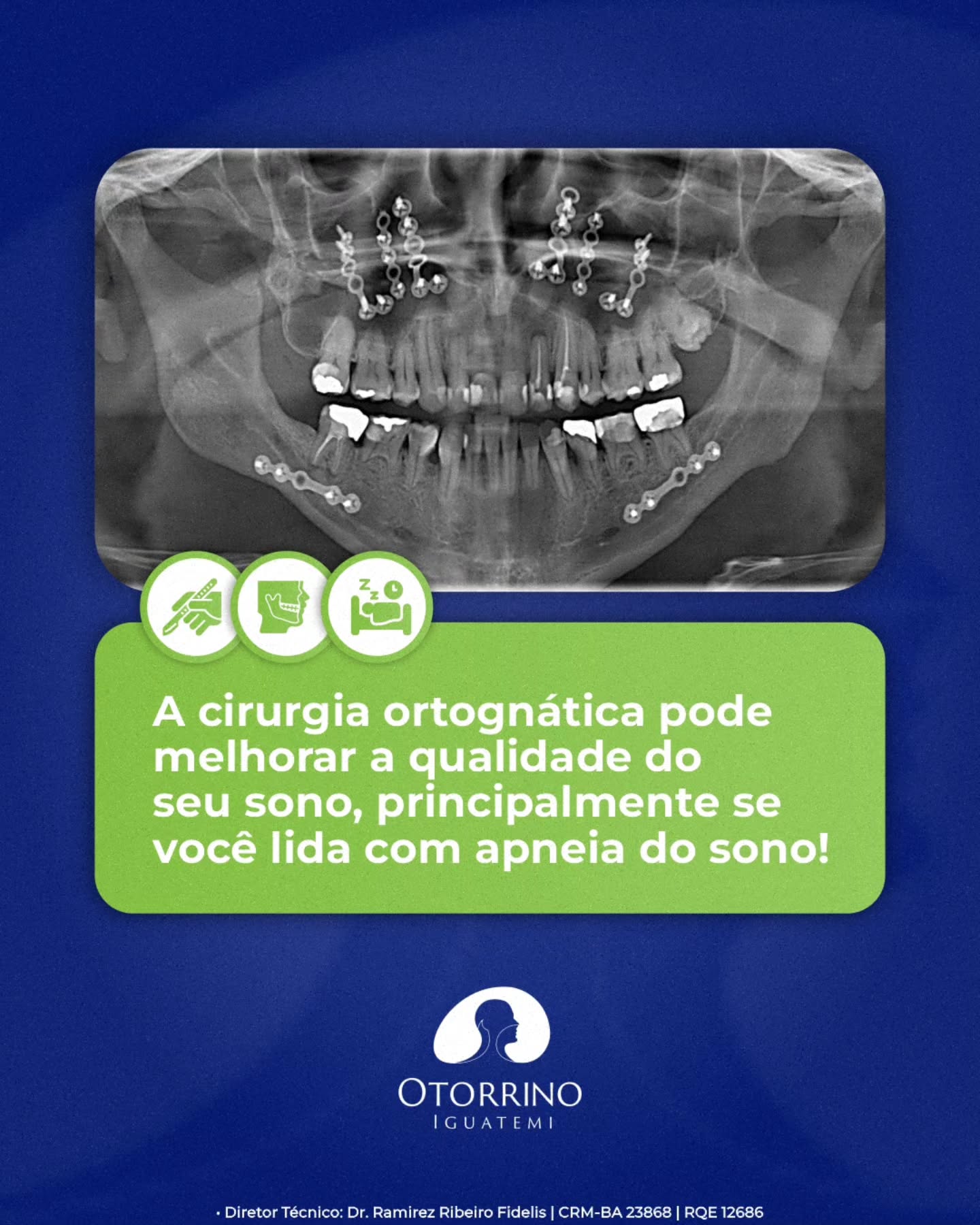 Você sabia que a cirurgia ortognática pode melhorar a qualidade do seu sono