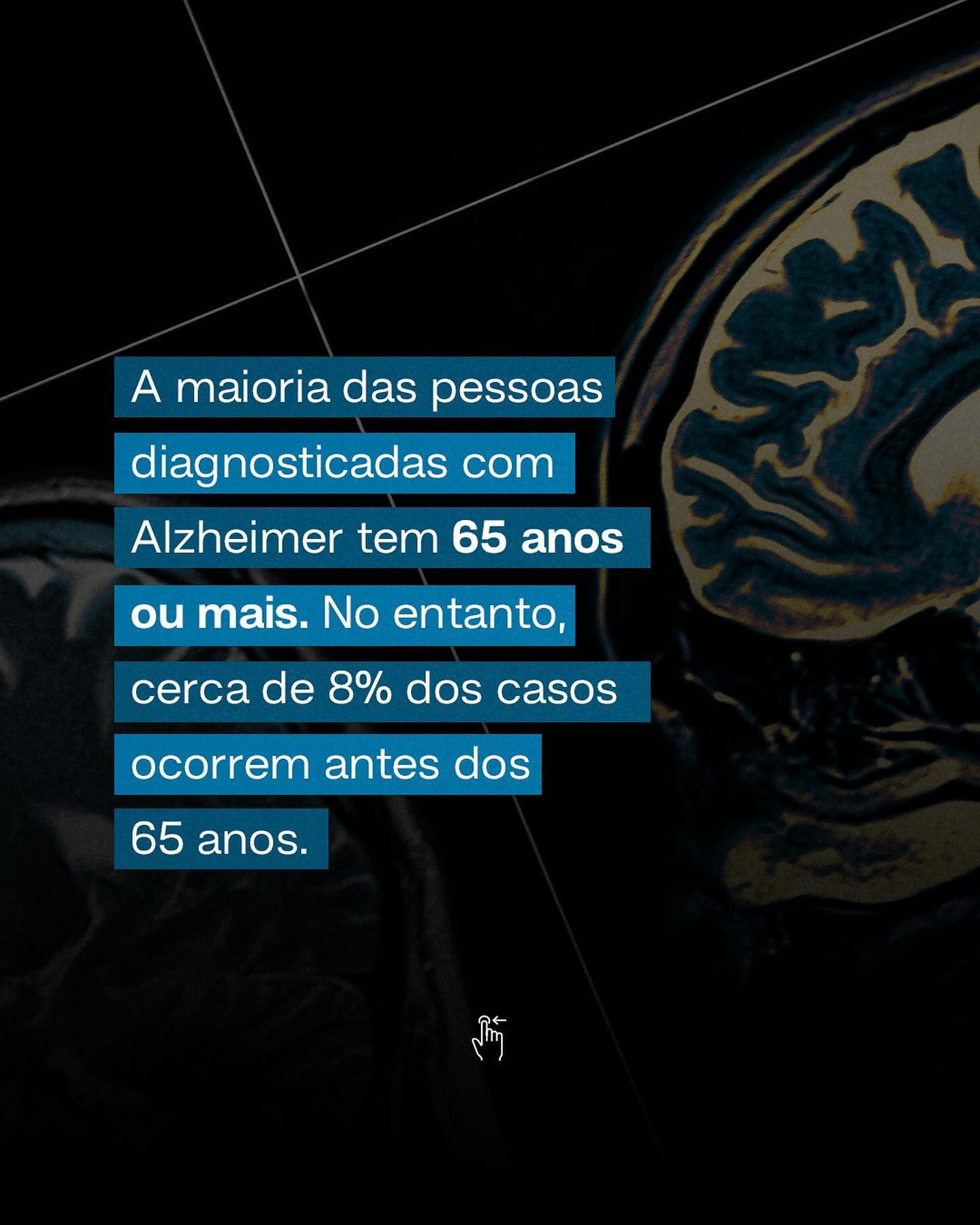 O Alzheimer só atinge idosos?