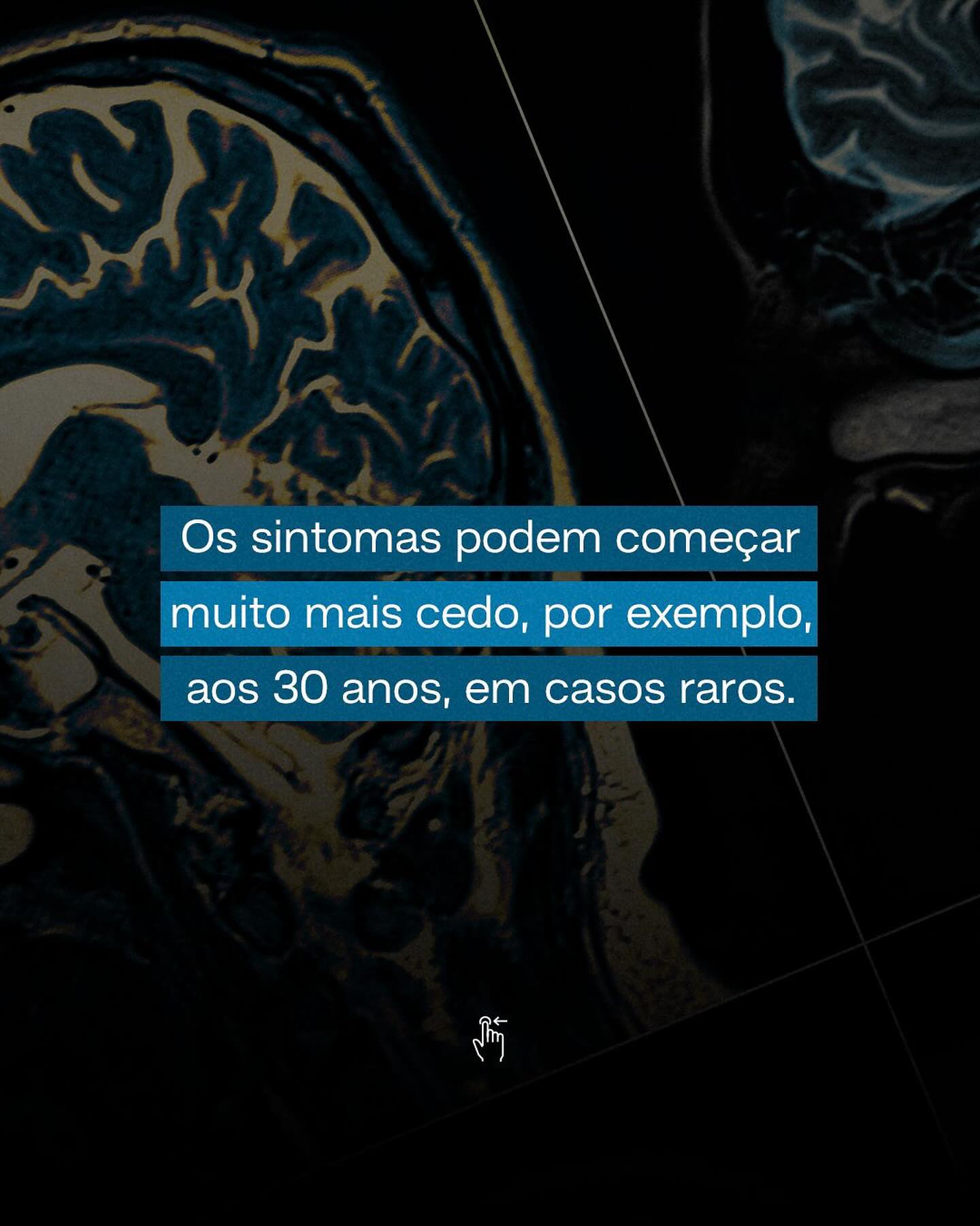 O Alzheimer só atinge idosos?