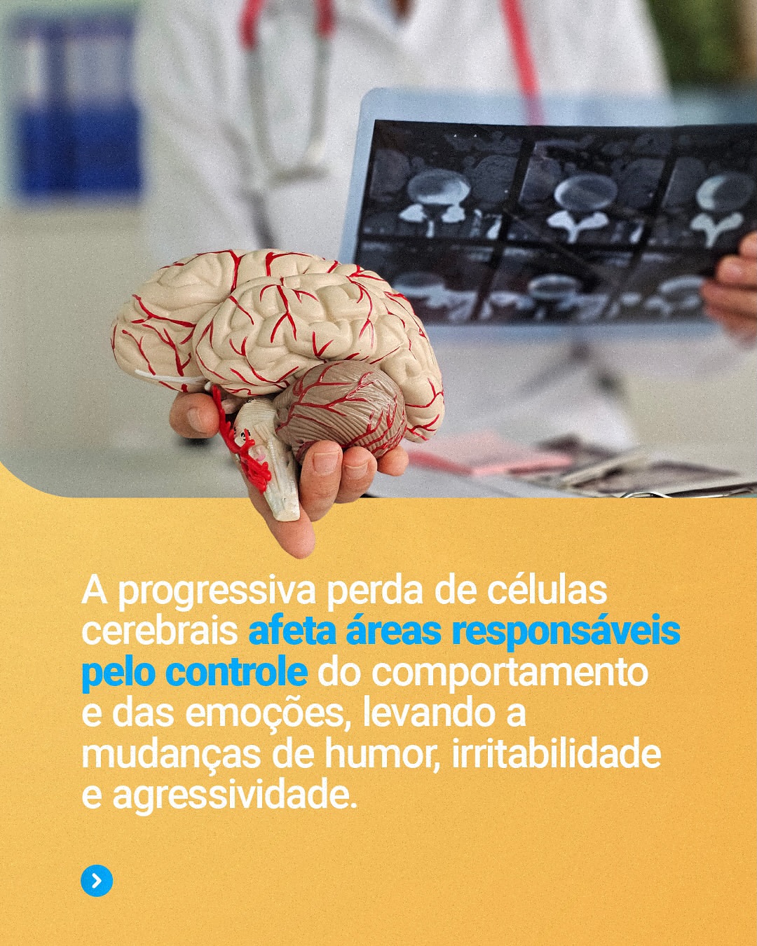 Por que a agressividade é um sintoma comum do Alzheimer?