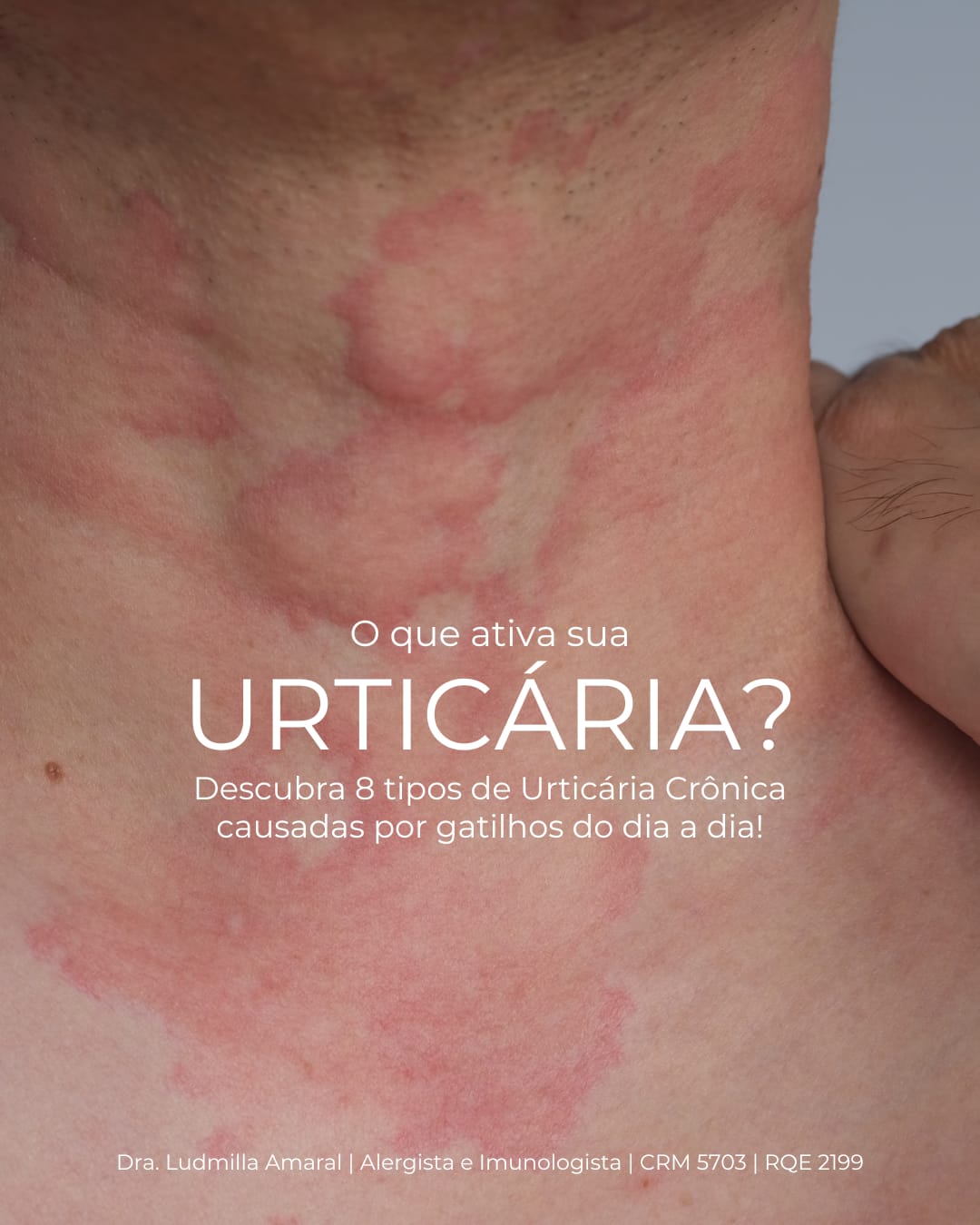 Urticária