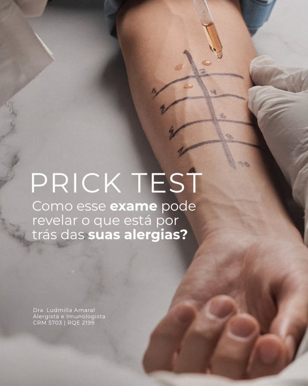Prick Test. Como esse exame pode revelar o que está por trás das suas alergias?