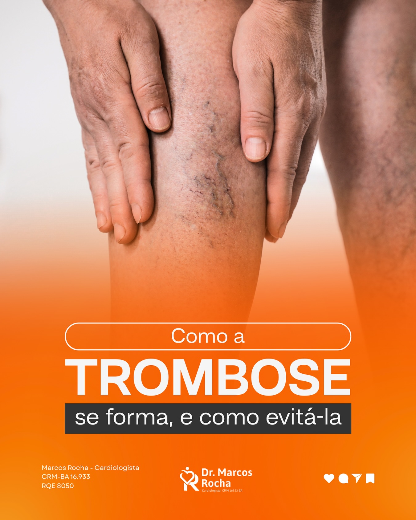 Como a Trombose se forma? Tem como evitar?