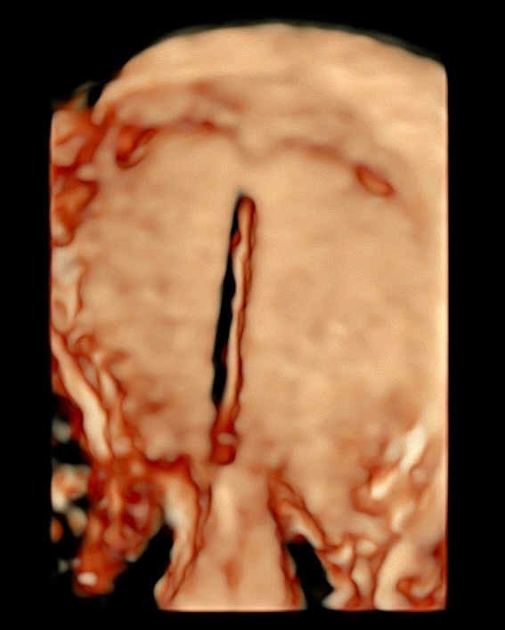 Ultrassonografia 3D no diagnóstico ginecológico: um olhar mais profundo e preciso