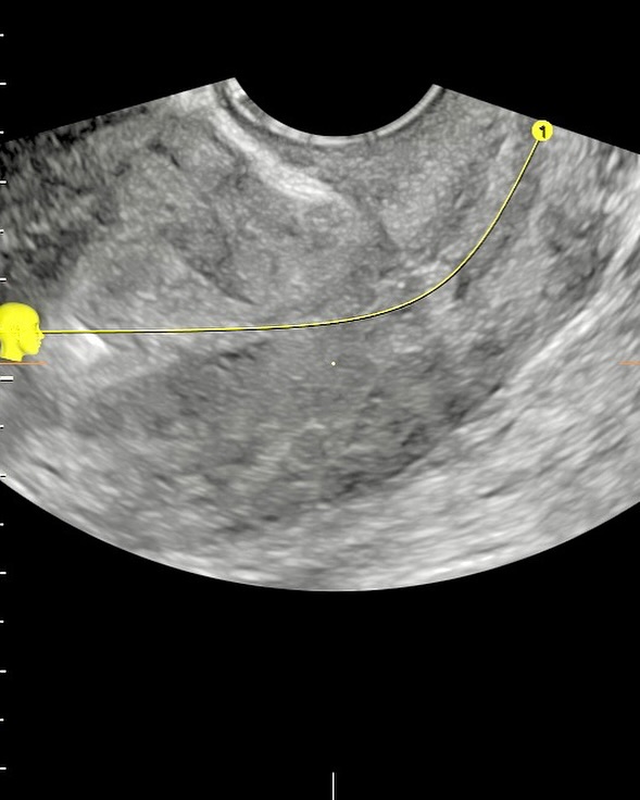 Ultrassonografia 3D no diagnóstico ginecológico: um olhar mais profundo e preciso