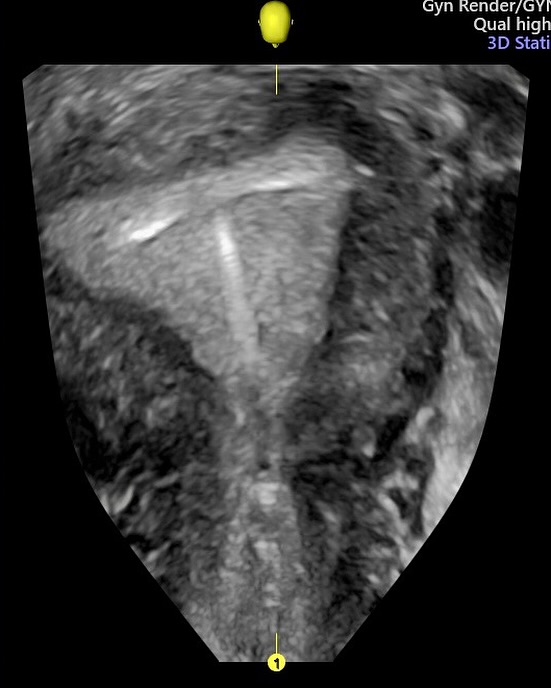Ultrassonografia 3D no diagnóstico ginecológico: um olhar mais profundo e preciso