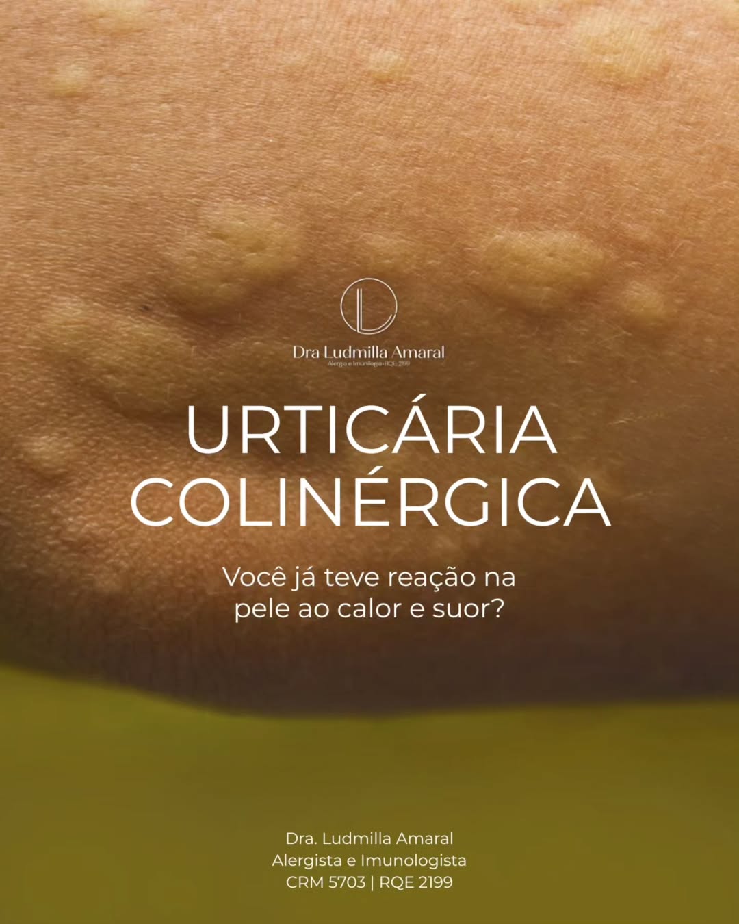 Urticária Colinérgica. Você já teve reação na pele ao calor e suor?
