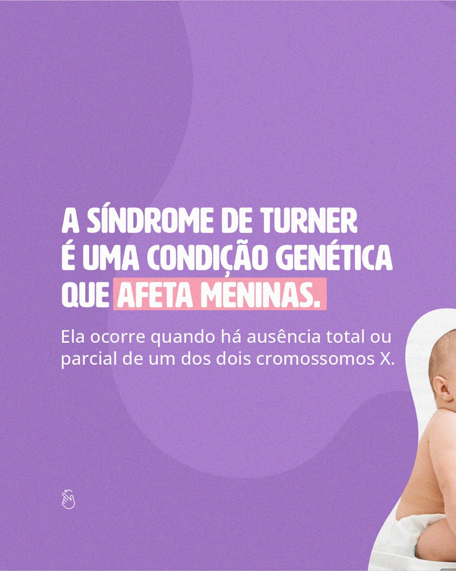 Síndrome Turner