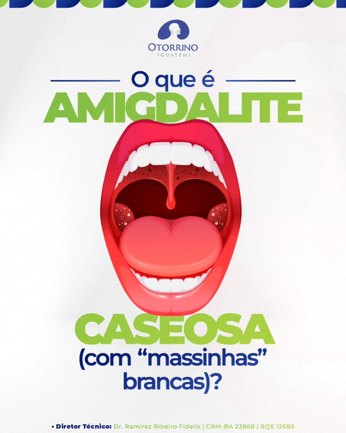 Você já sentiu aquele incômodo na garganta e notou umas “massinhas” brancas aparecendo ali?