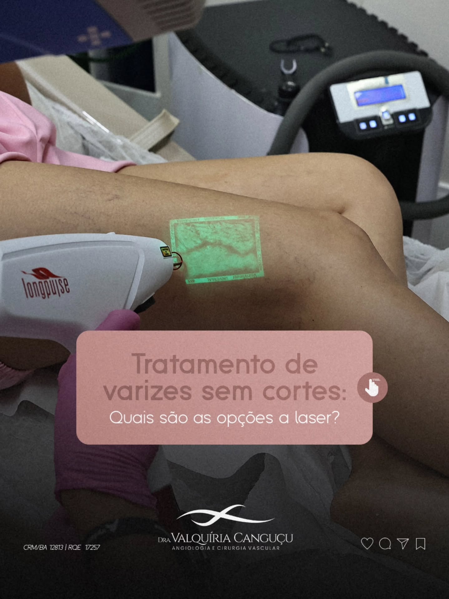 Você sabia que já é possível tratar varizes sem precisar de cortes?