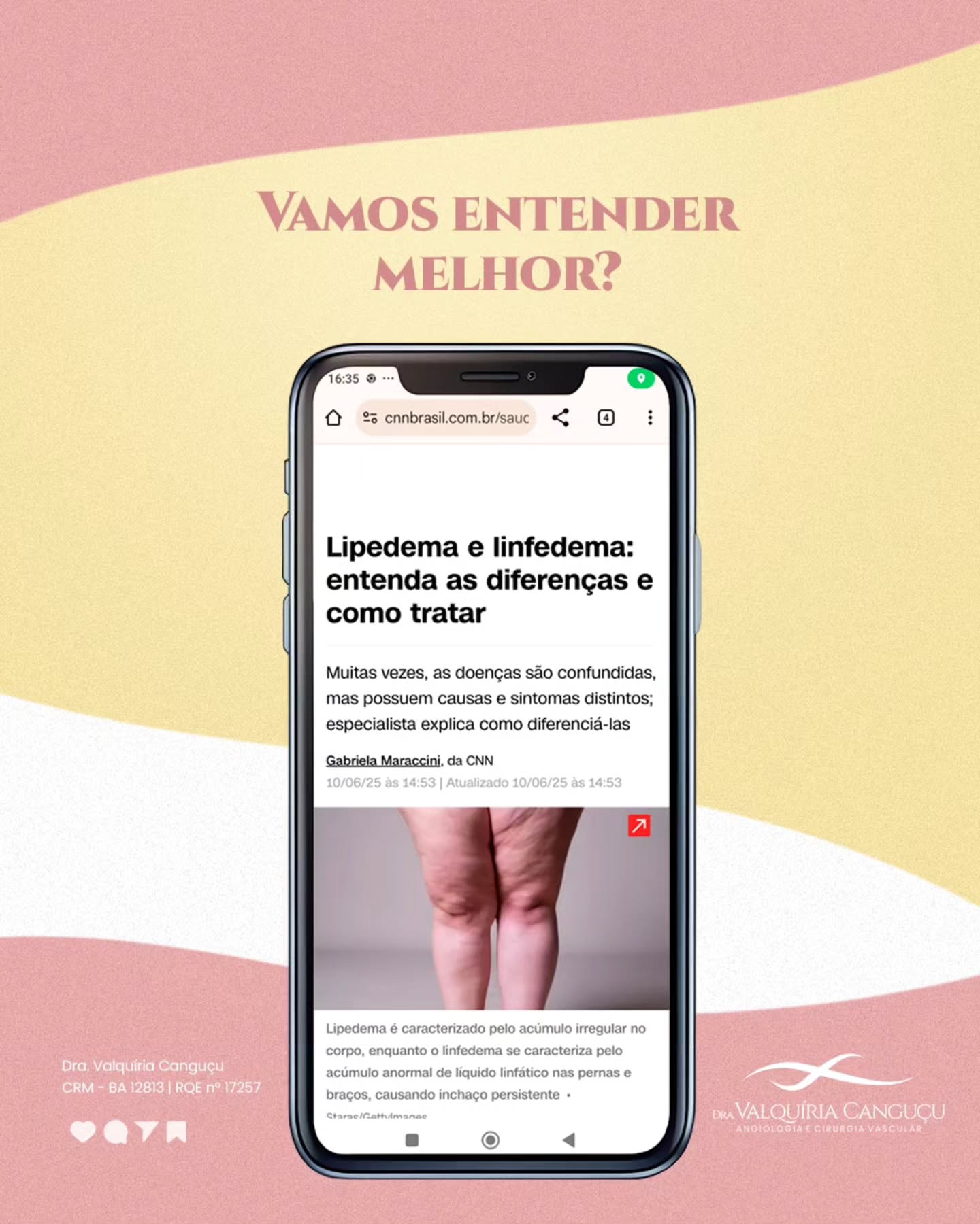 Você sabe qual é a diferença entre lipedema e linfedema?