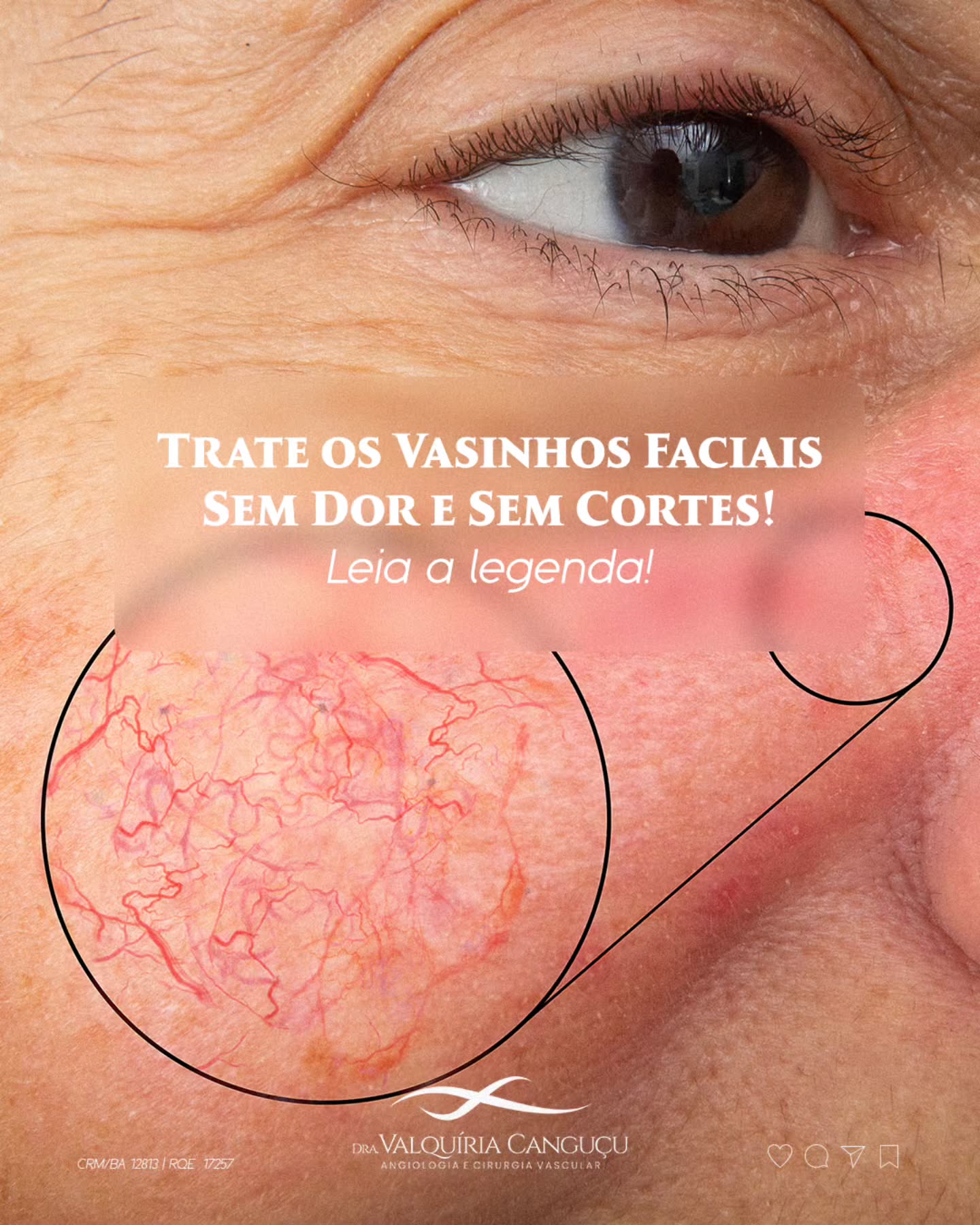 Você sente incômodo com vasinhos no rosto e não sabe como resolver?