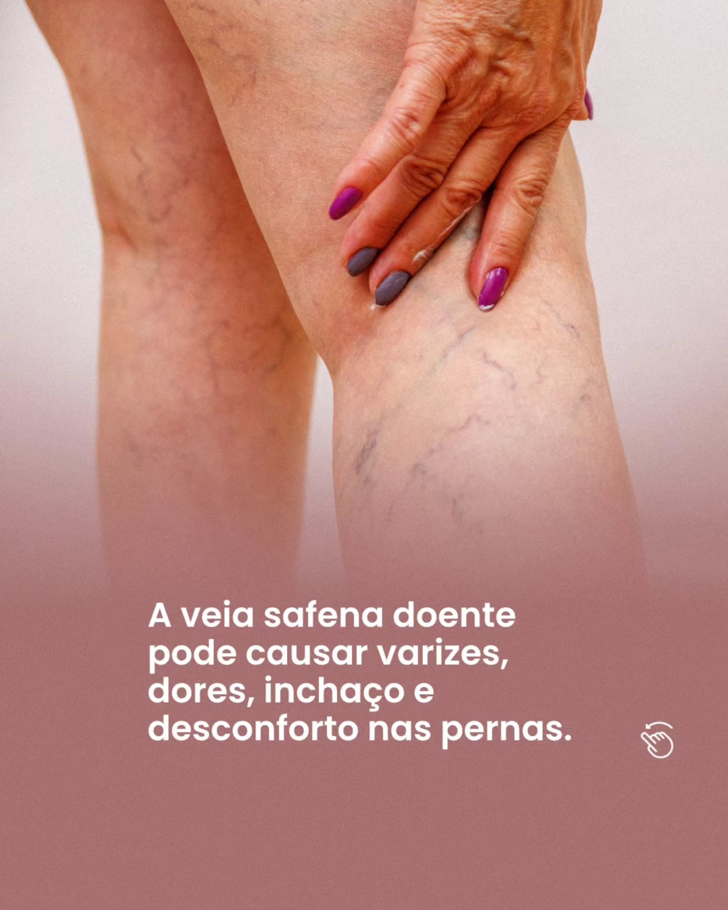 Você sonha em tratar sua veia safena sem cirurgia?
