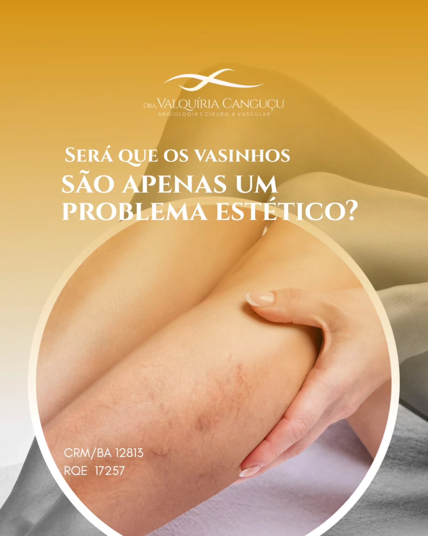 Você já se incomodou com vasinhos nas pernas?