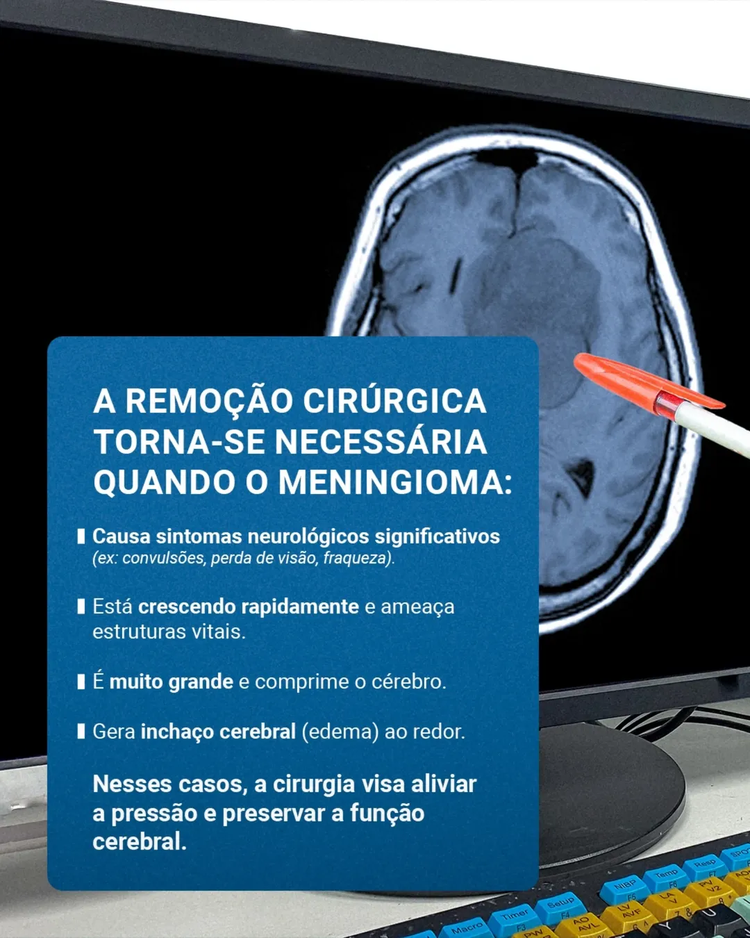 Meningioma: Descobri e agora? Acompanhar ou Operar?