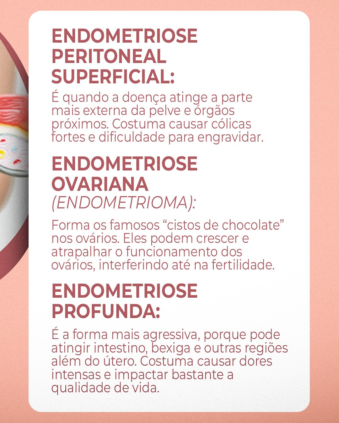 Endometriose não é tudo igual.