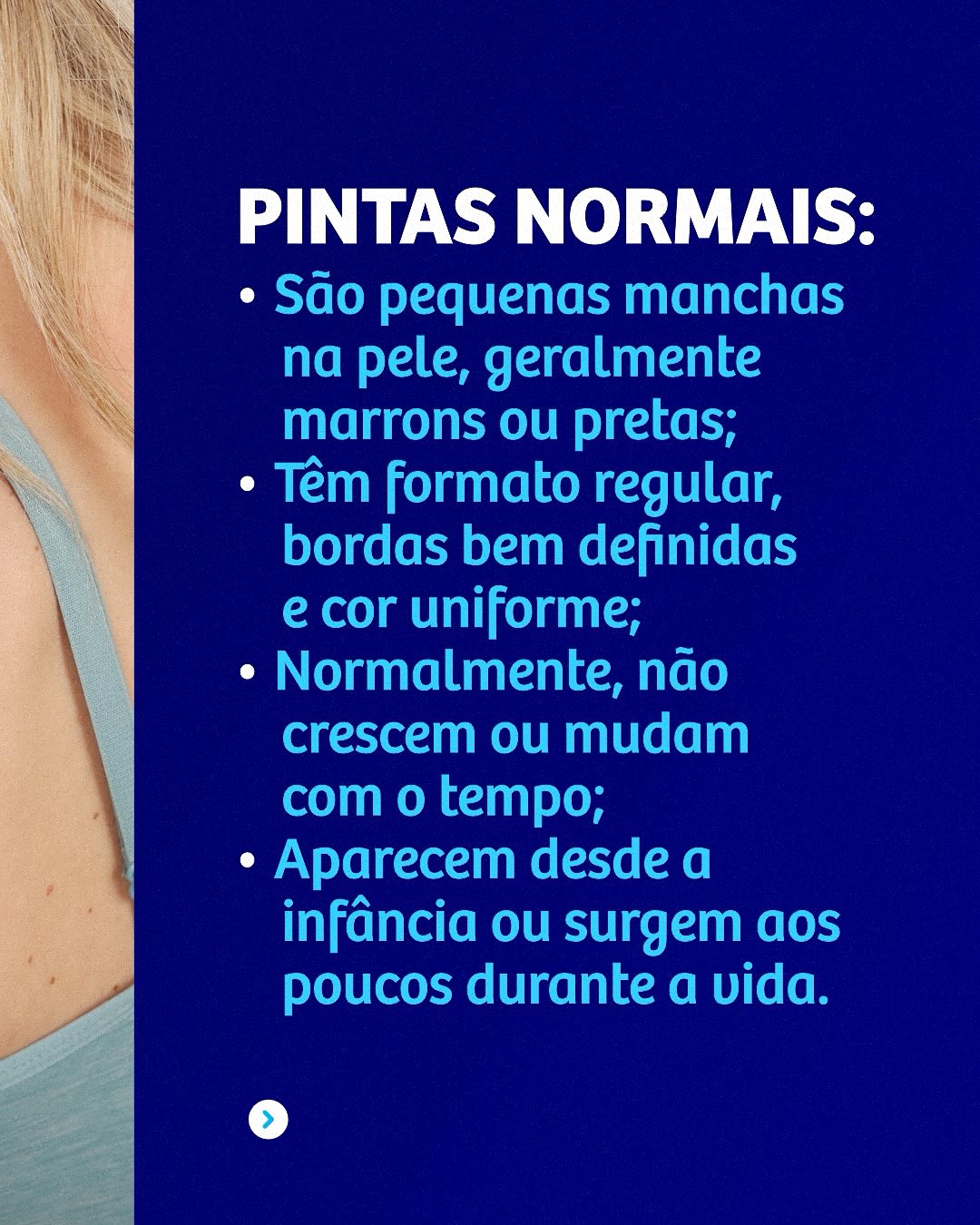 Diferença entre pintas normais e suspeitas: Quando procurar um especialista?