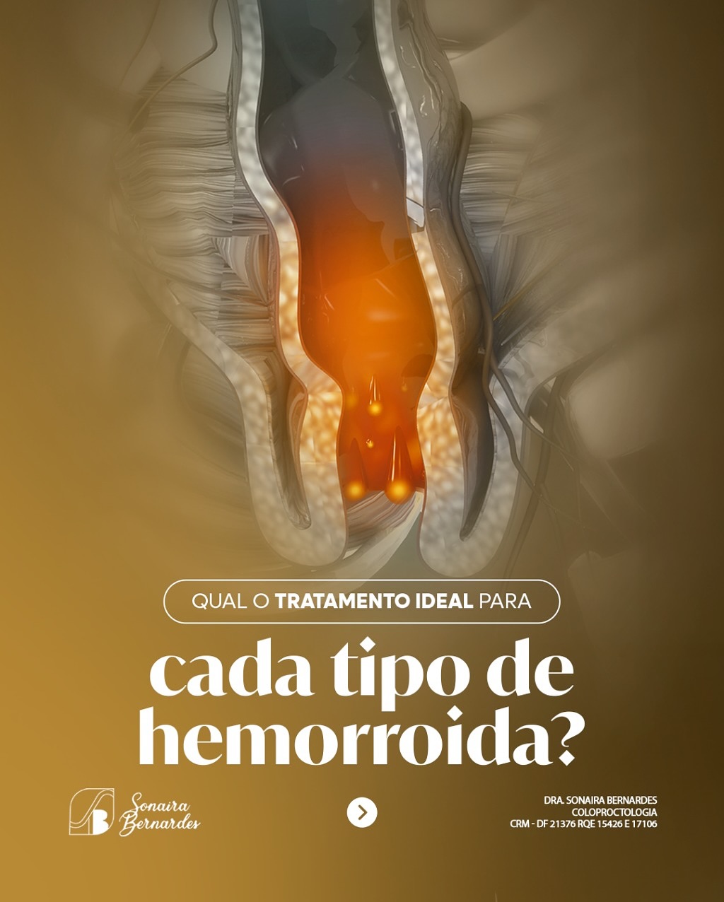 Toda hemorroida têm o mesmo tratamento?