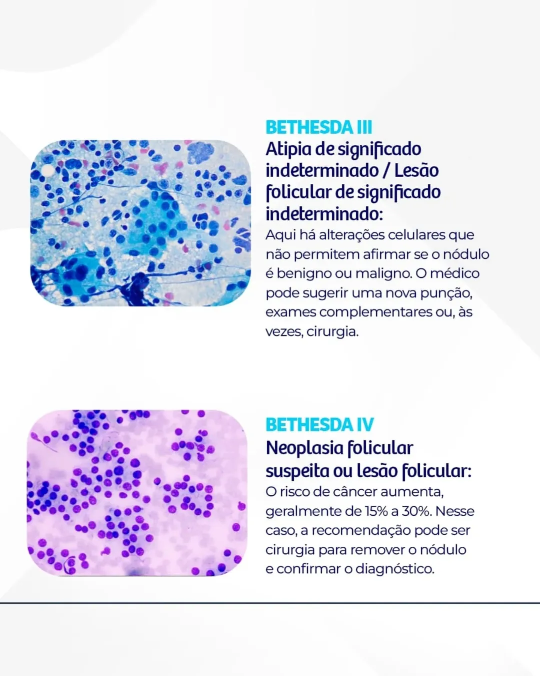 O que significa a classificação de Bethesda nos nódulos tireoidianos?