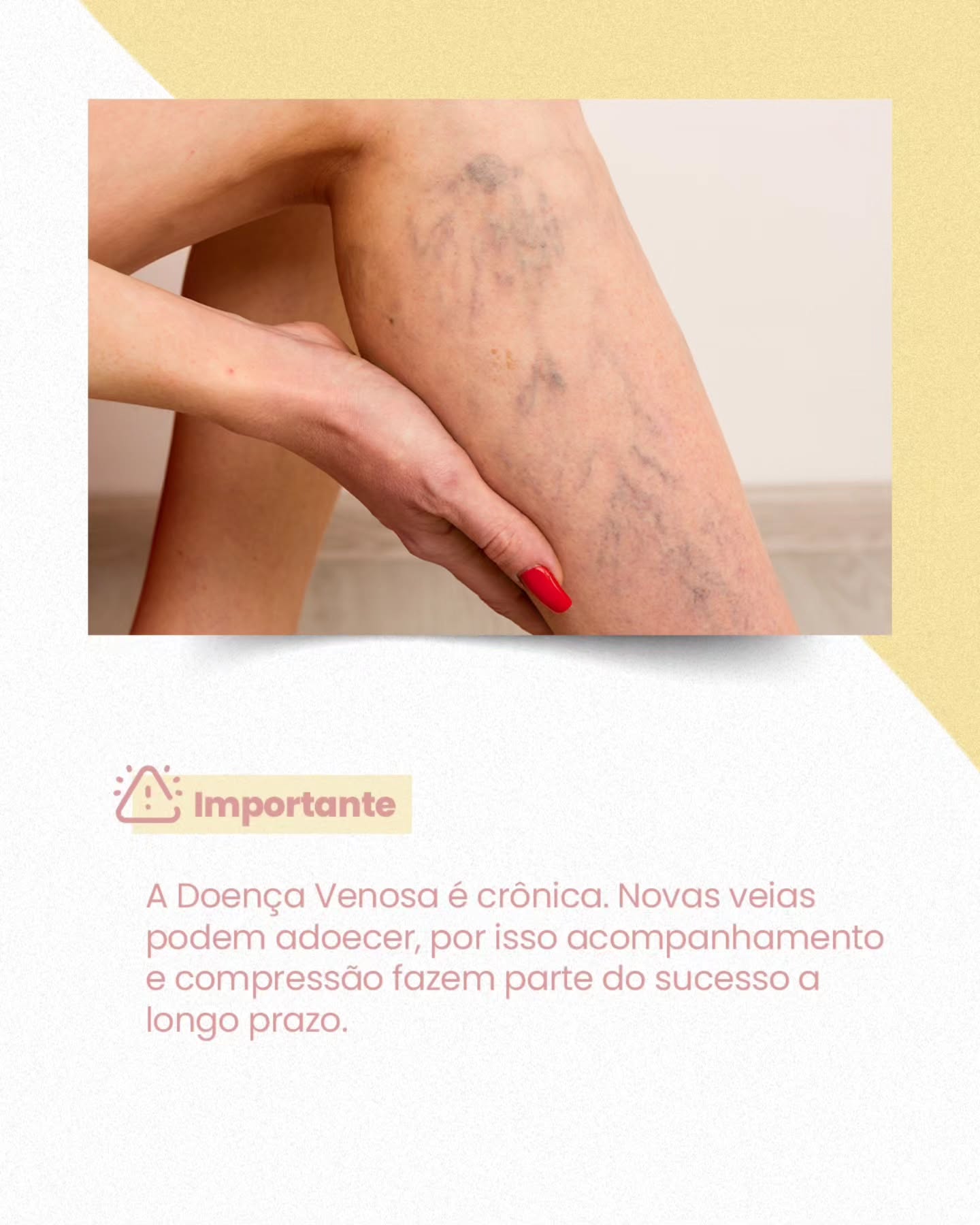 Você já parou para perceber se o seu tratamento de varizes realmente está fazendo diferença no seu dia a dia?