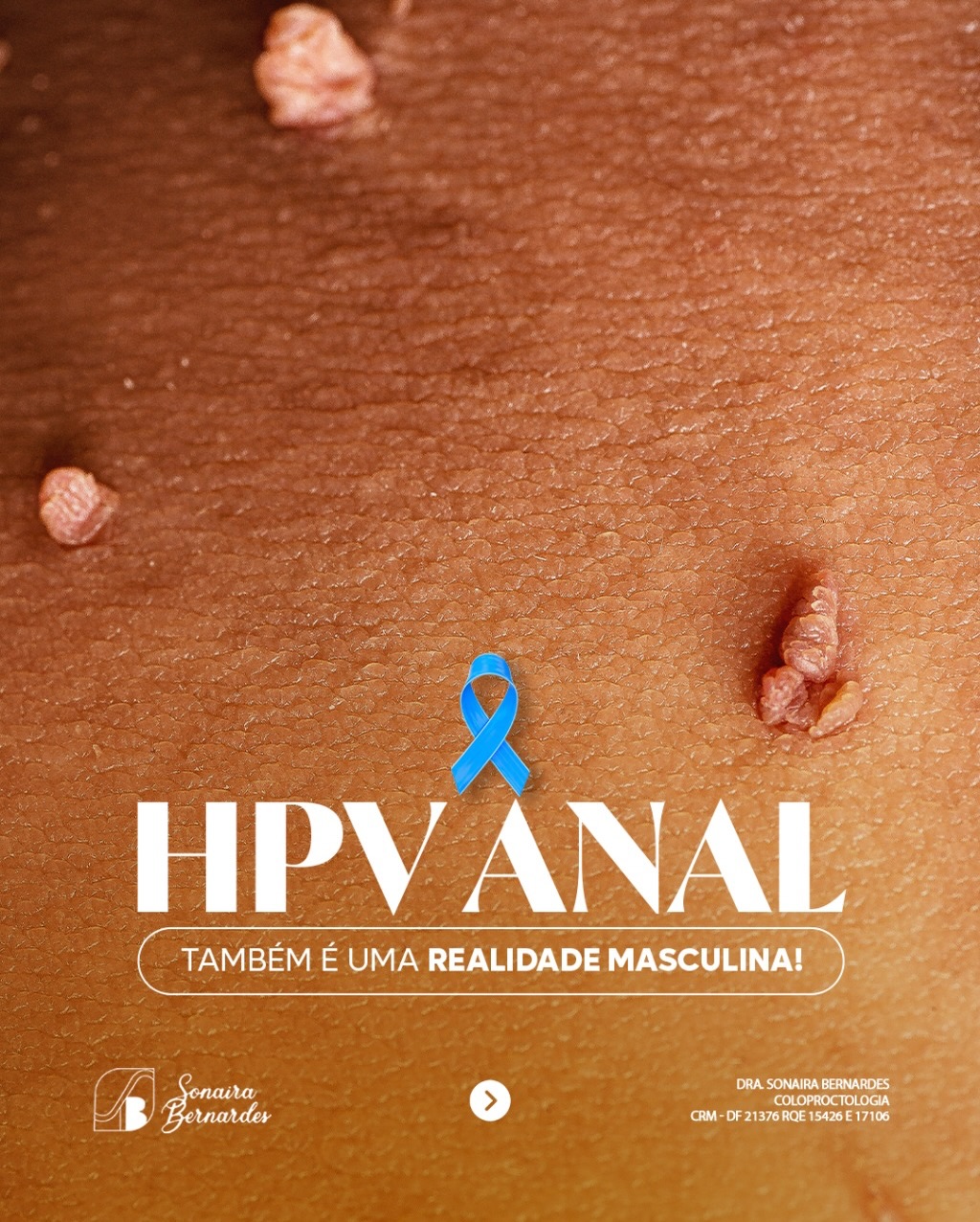 Sabia que o HPV pode afetar homens, causando verrugas genitais e até câncer anal?