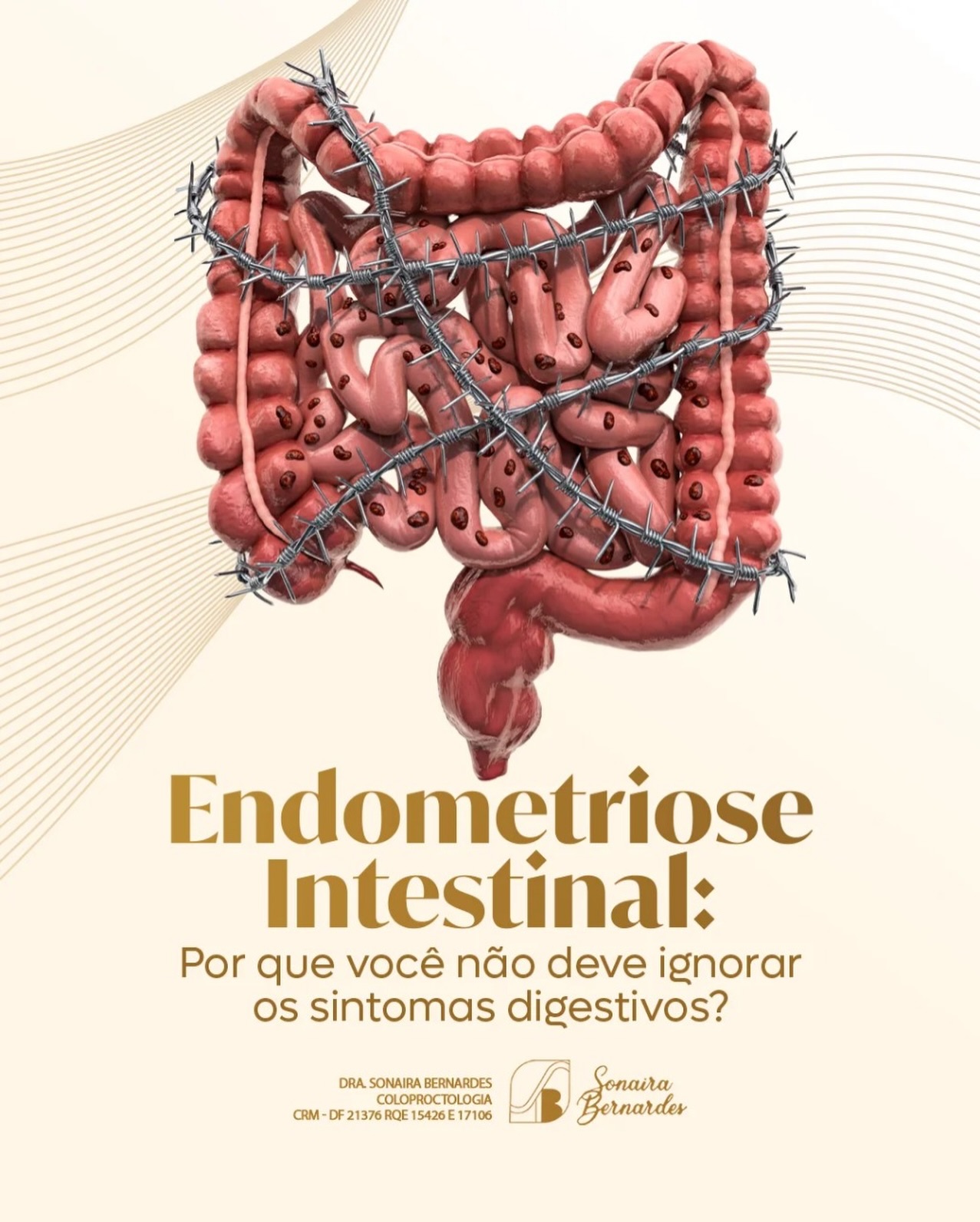 Endometriose intestinal