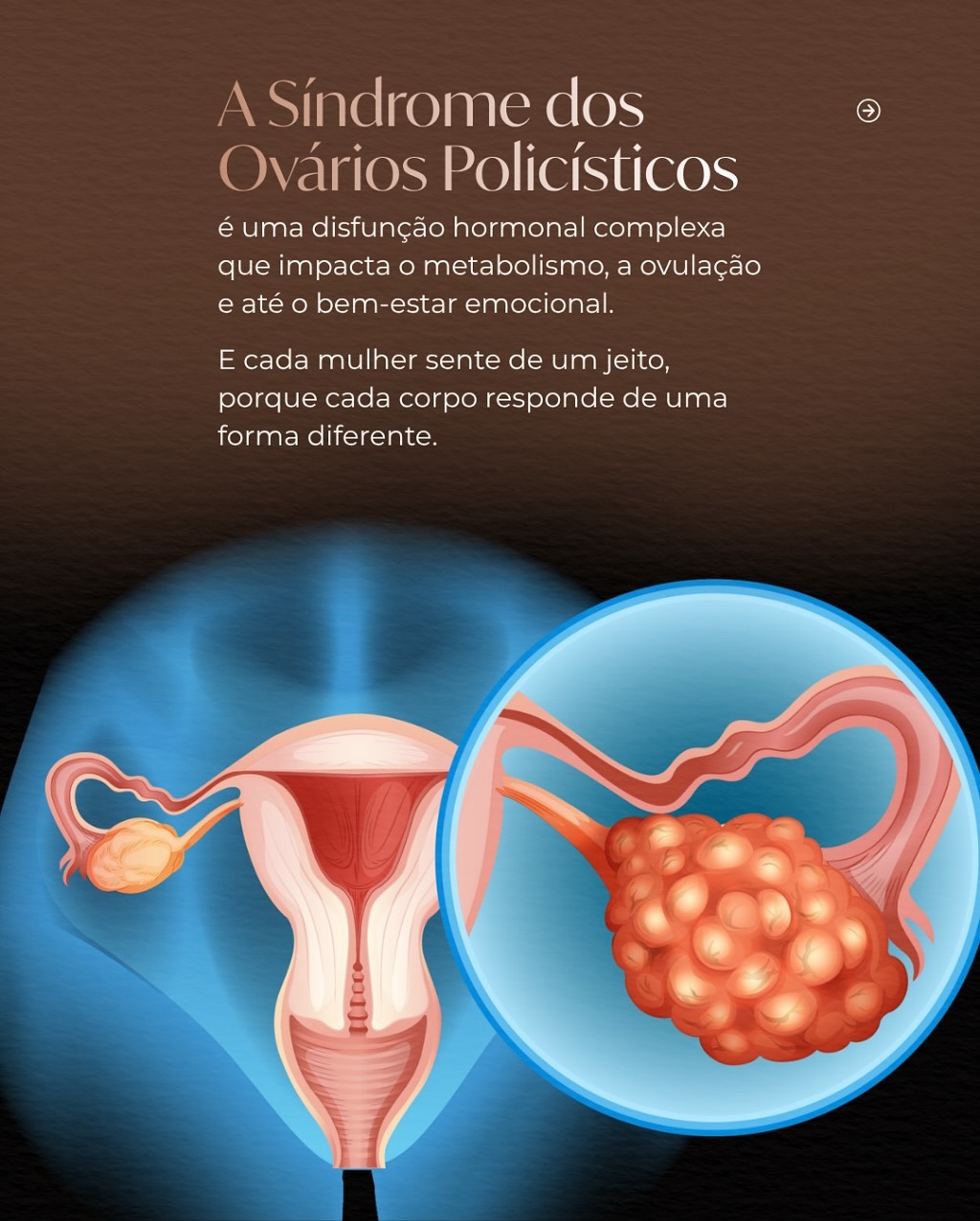 Síndrome dos Ovários Poliscísticos - SOP