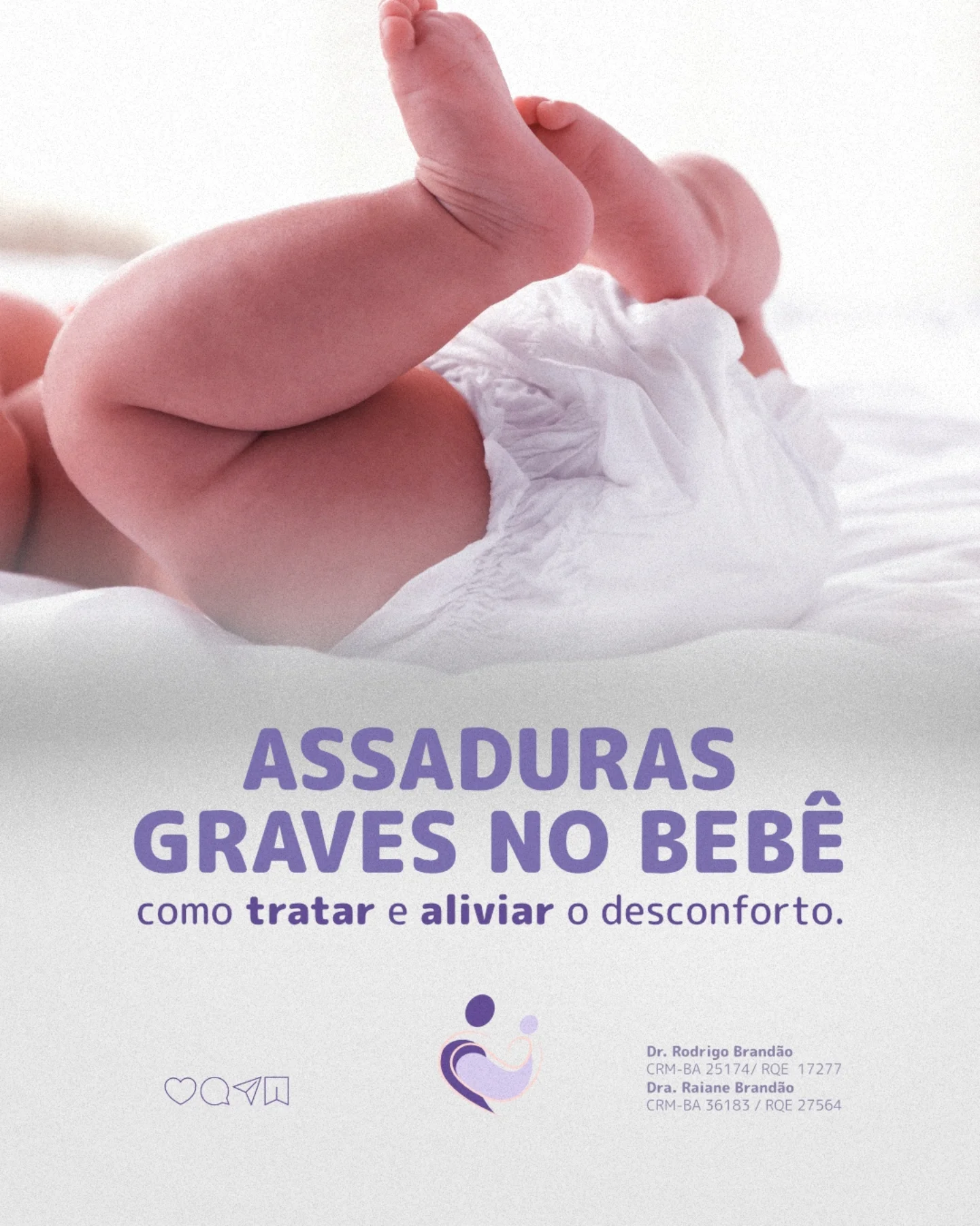 Assaduras graves no bebê