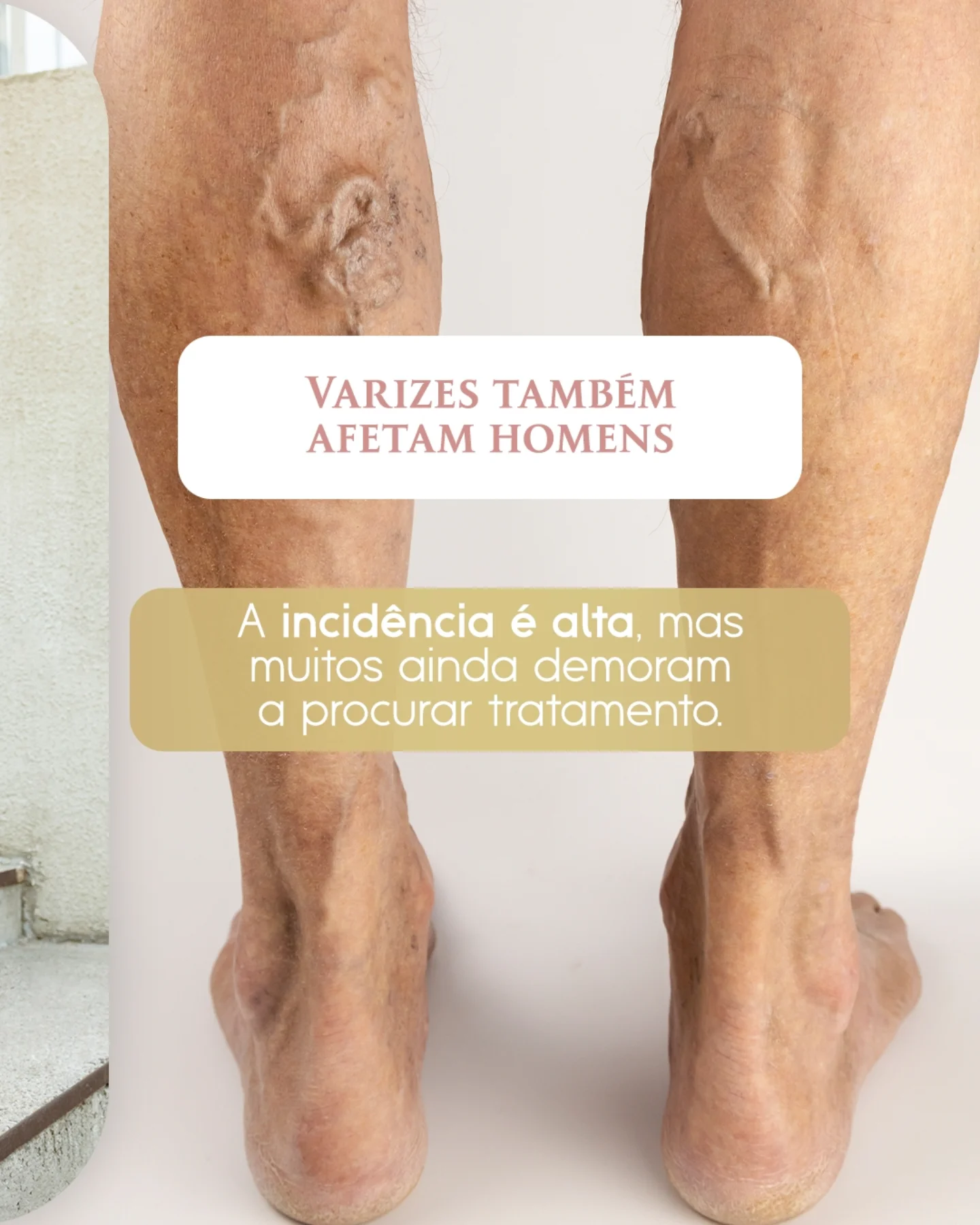 Você acha que já sabe tudo sobre varizes?