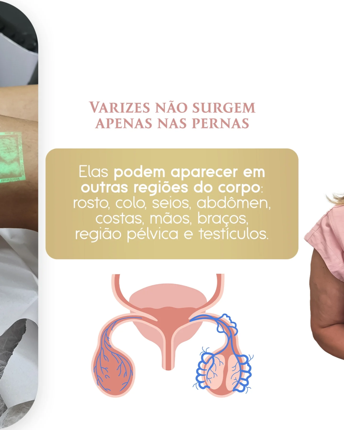 Você acha que já sabe tudo sobre varizes?