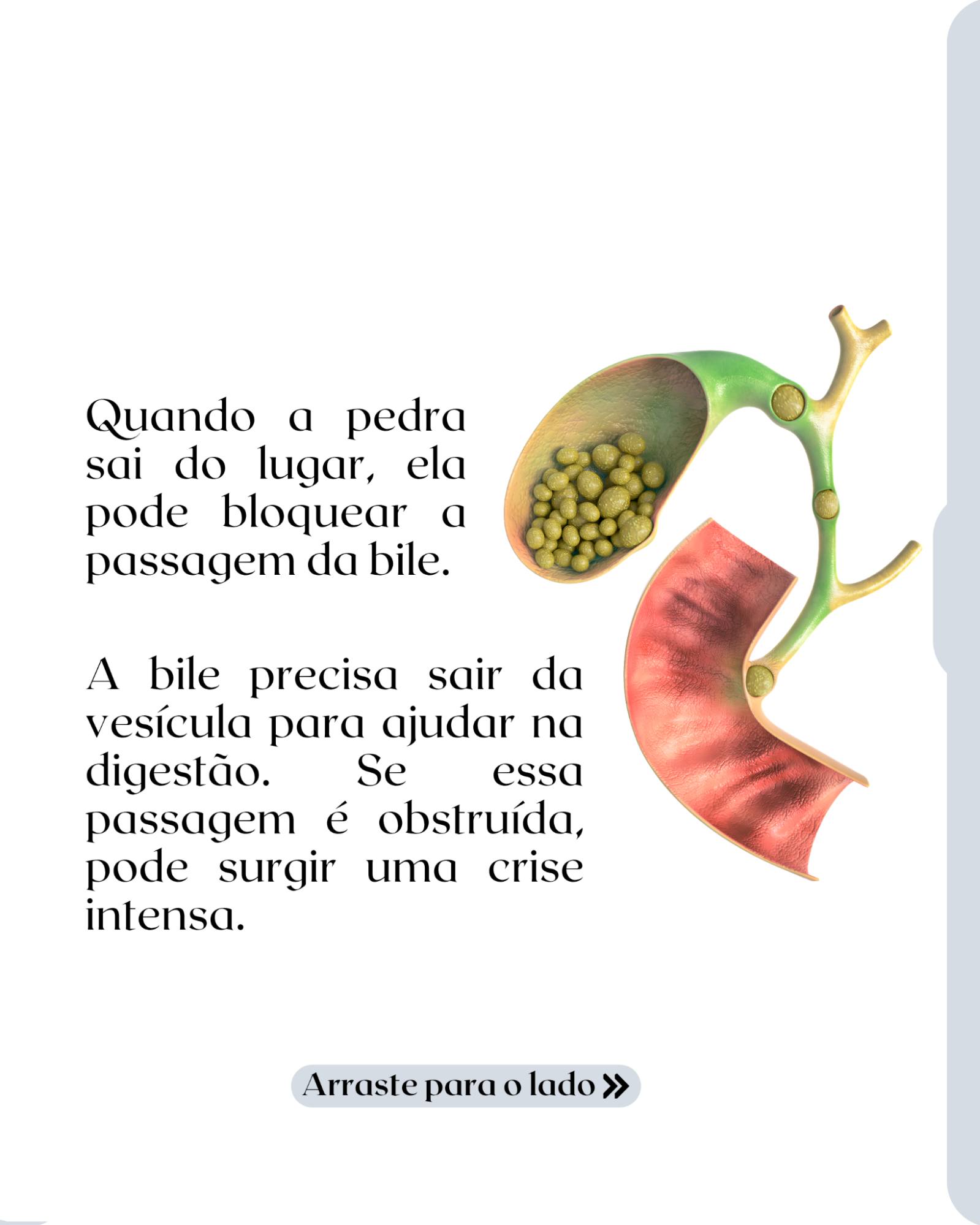 Pedra na vesícula não avisa quando vai complicar.