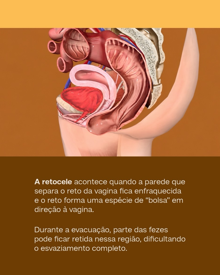 O que  retocele?