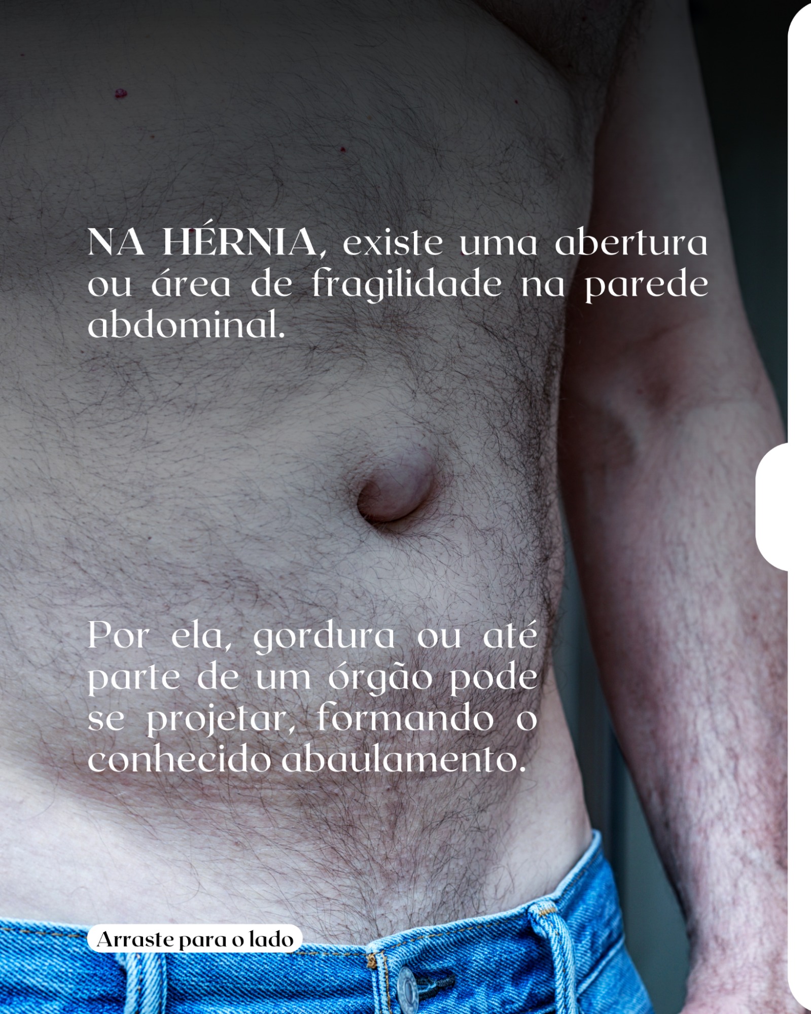 Você percebe um abaulamento no abdômen e pensa: “é hérnia”.