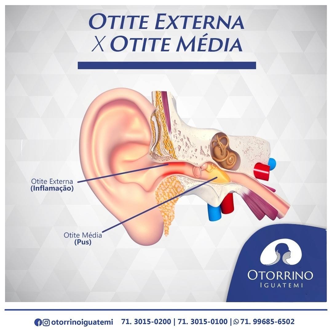 Em ambos os casos não deixe de consultar um otorrinolaringologista.