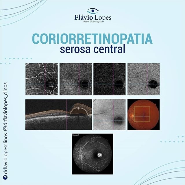 Dr Flavio Lopes aos cuidados da saúde dos seus olhos!