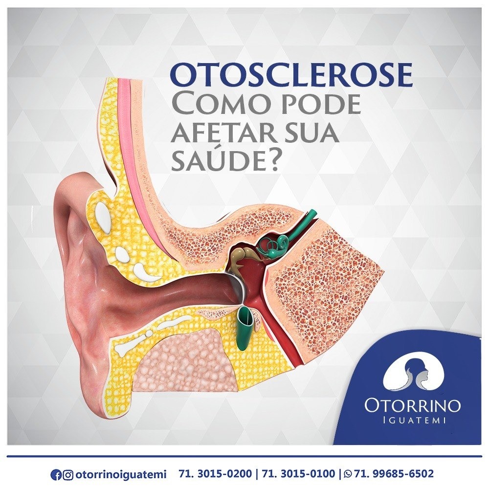 Otorrino Iguatemi em: A otosclerose.