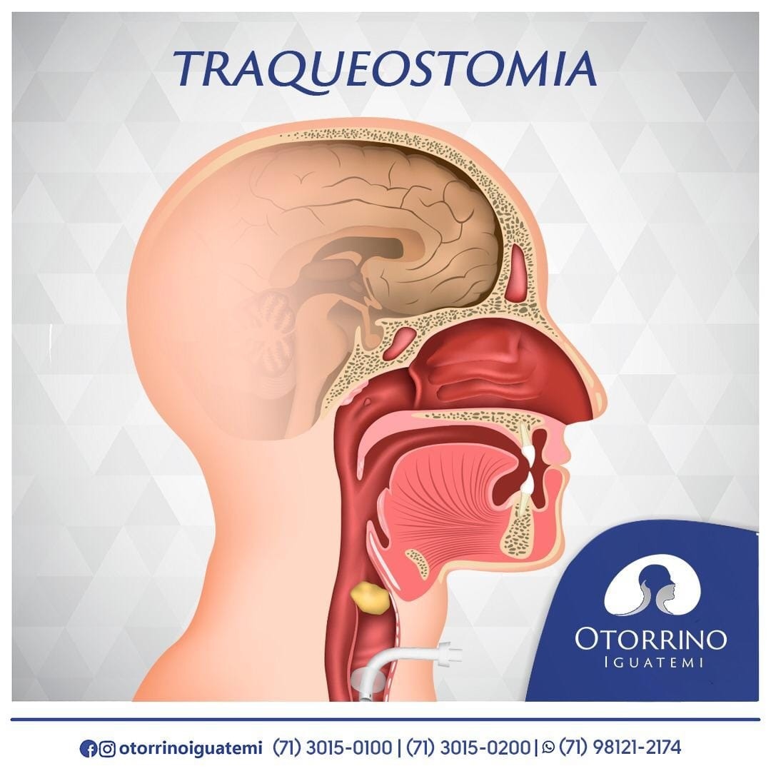 O que é traqueostomia?