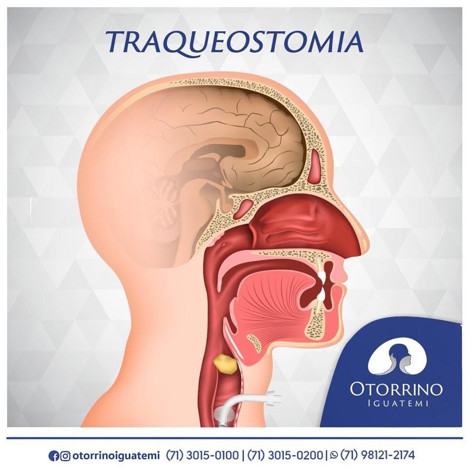 Você sabe o que é Traqueostomia?