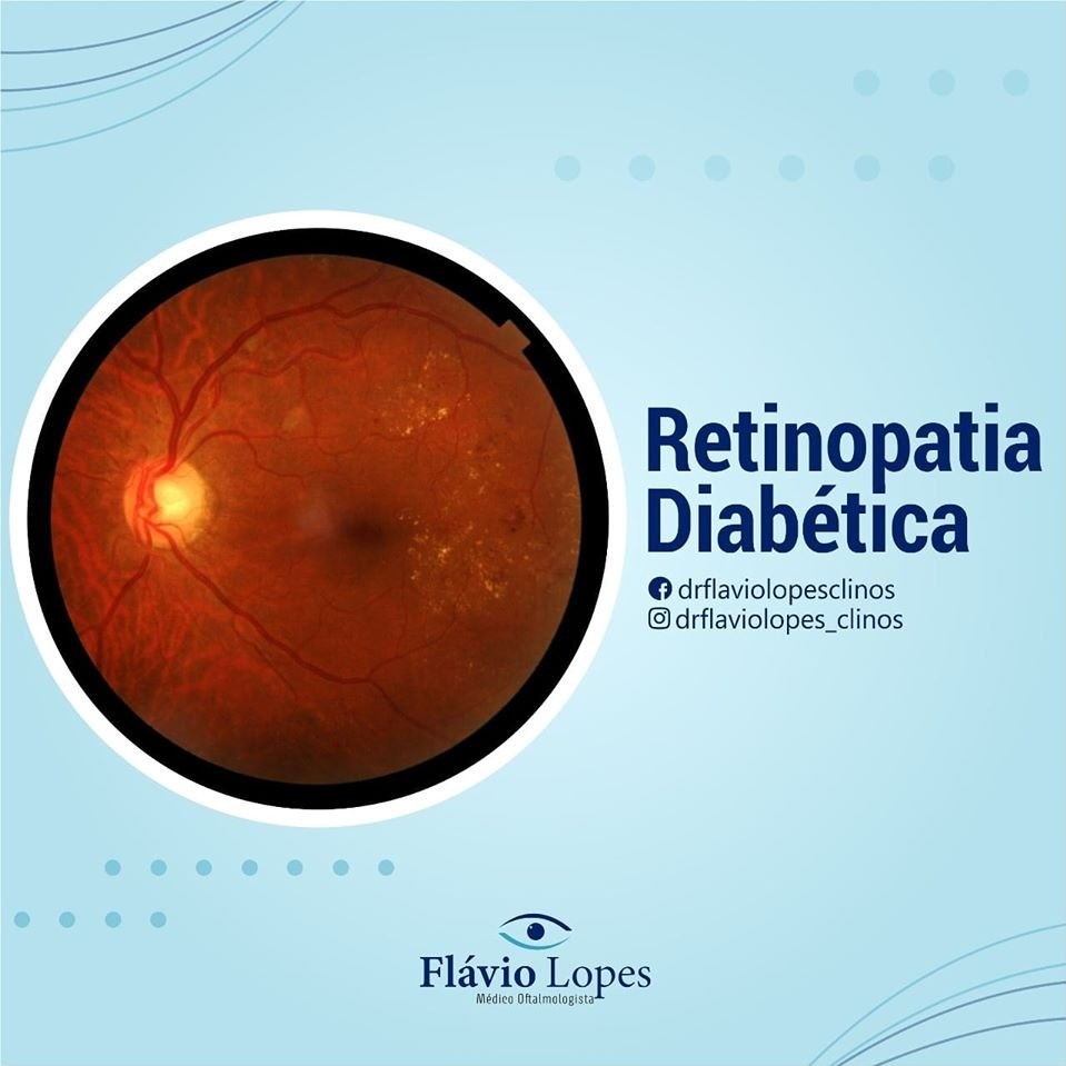 Você já sabia que a retina pode ser afetada pelo diabetes?