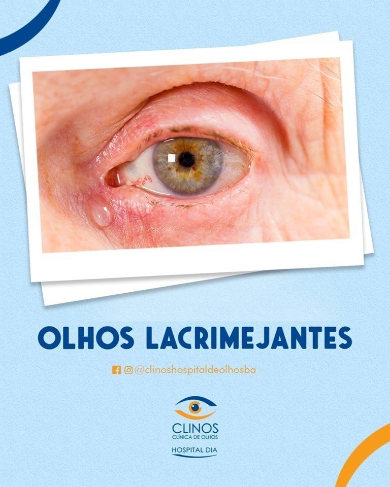 Olhos Lacrimejantes!