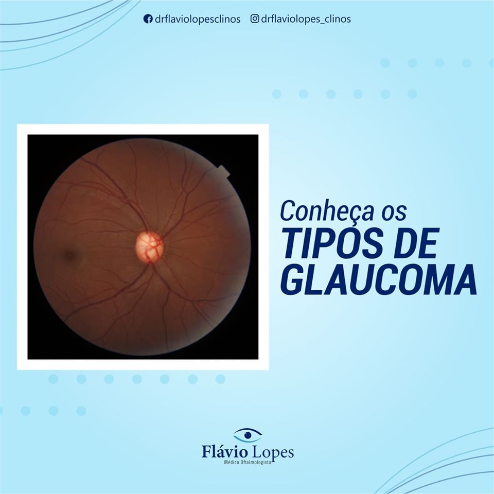 Falando sobre os tipos de glaucoma.